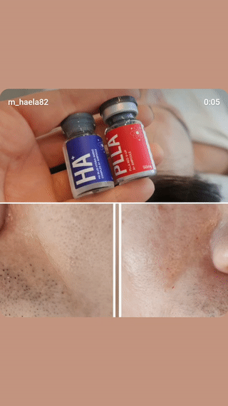 미레브 HA 블루 하이드라 아미노 컴플렉스 에이플러스 앰플 (5ml * 5val) 상세 안내 1