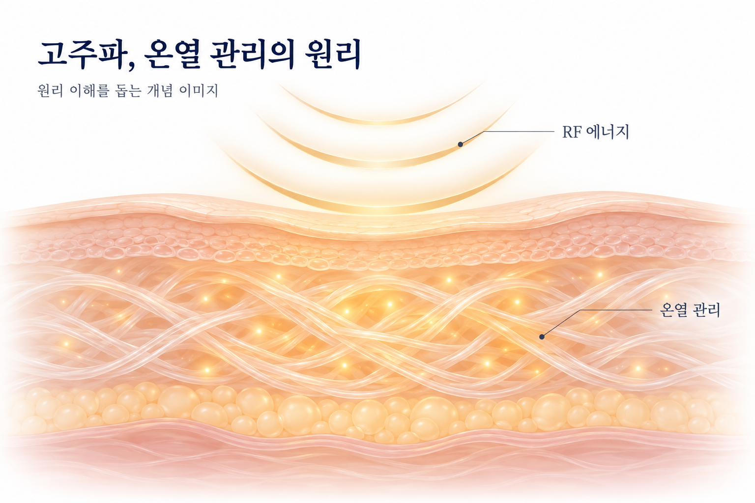 고주파 에너지와 온열 관리의 개념